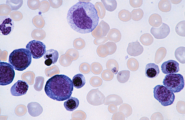  bone marrow smear, erythroblast series with proerythroblast 
