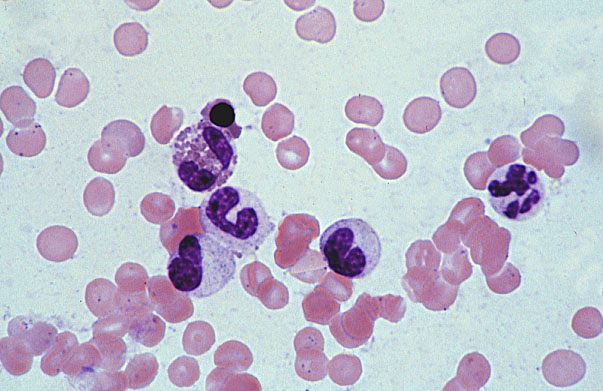  bone marrow smear, neutrophilic metamyelocyte and mature PMN 