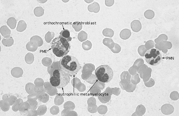  bone marrow smear, neutrophilic metamyelocyte and mature PMN 