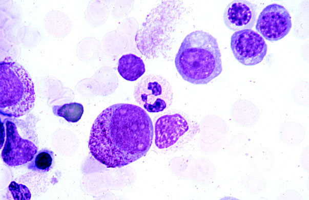  bone marrow smear, promyelocyte and erythroblasts 