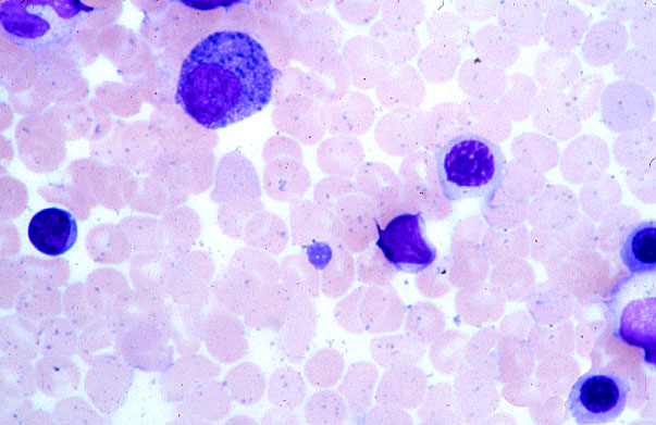  bone marrow smear, basophilic myelocyte 