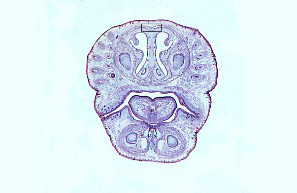  fetal head I 
