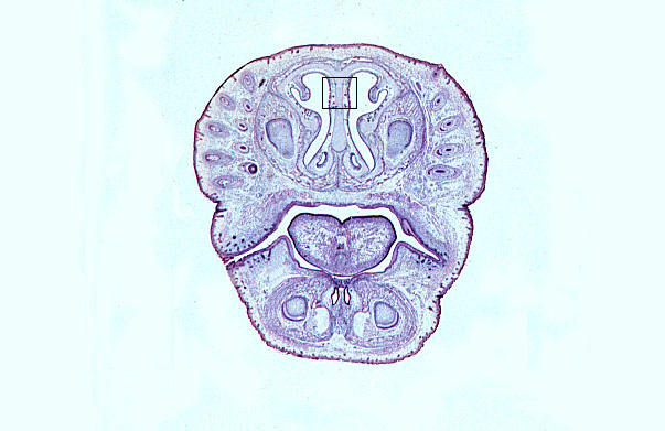  fetal head III 