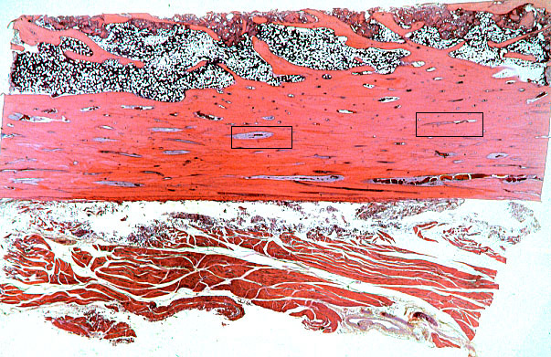  bone remodeling 