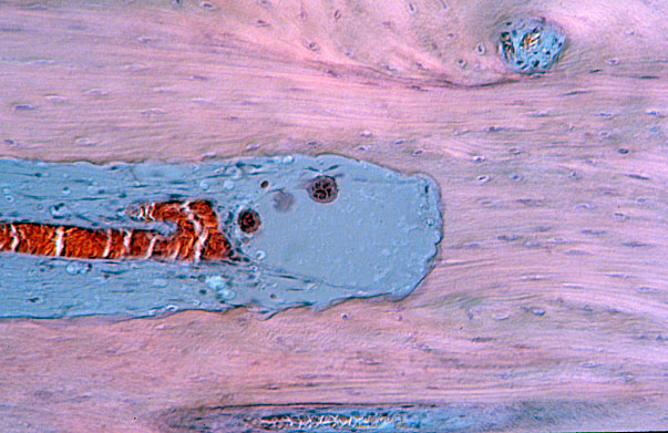 bone remodeling 