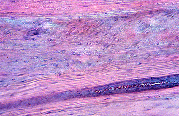  bone remodeling 