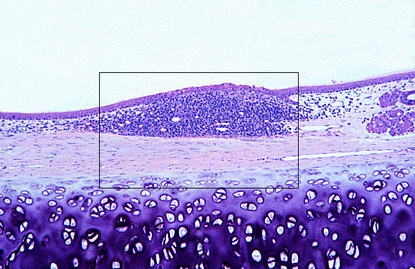  diffuse lymphoid tissue 