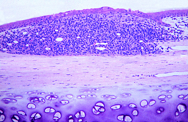  diffuse lymphoid tissue 