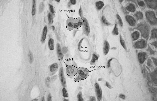  lamina propria, eosinophils and neutrophils 