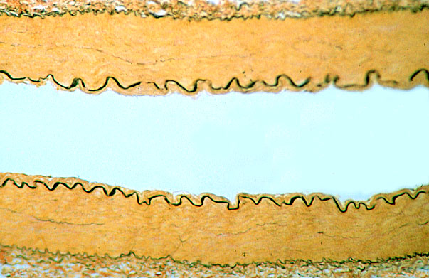  arteries, Verhoeff's 