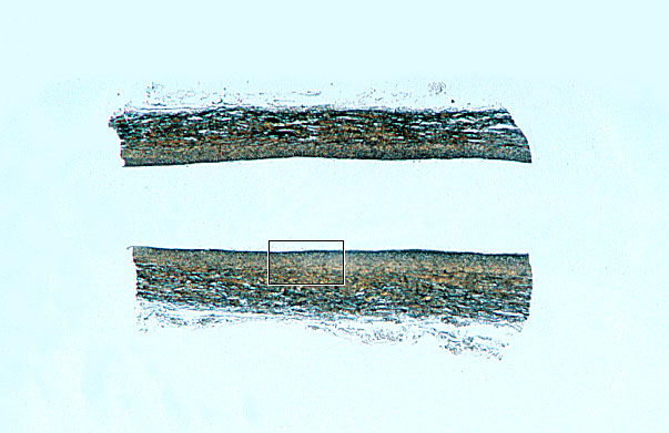  large vein, Verhoeff's 