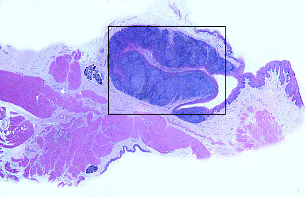  tonsil 