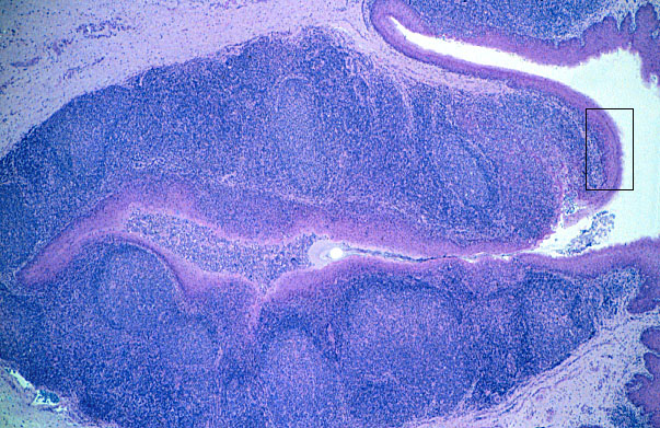  tonsil 