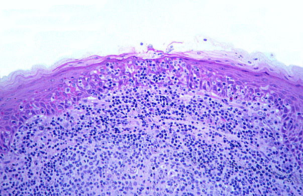  tonsil, reticulated epithelium 
