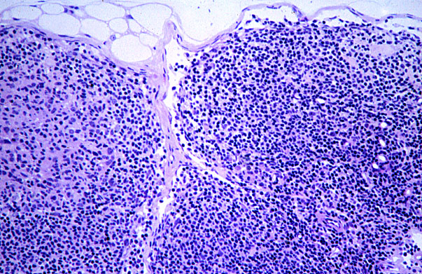 lymph node, subcapsular sinus 