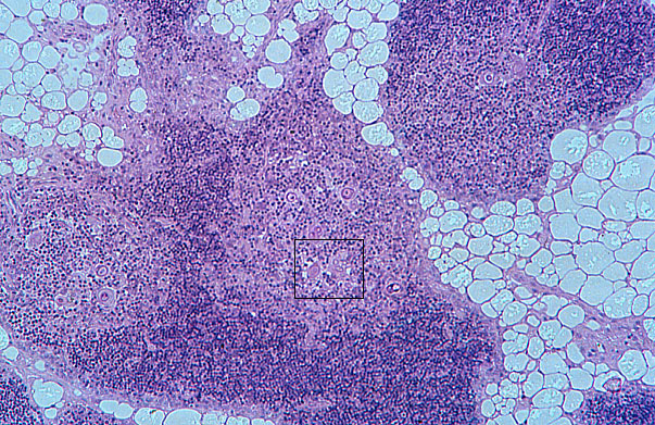 involuted thymus 