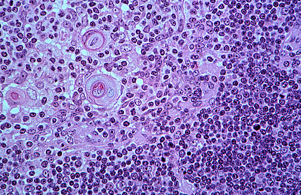  involuted thymus 