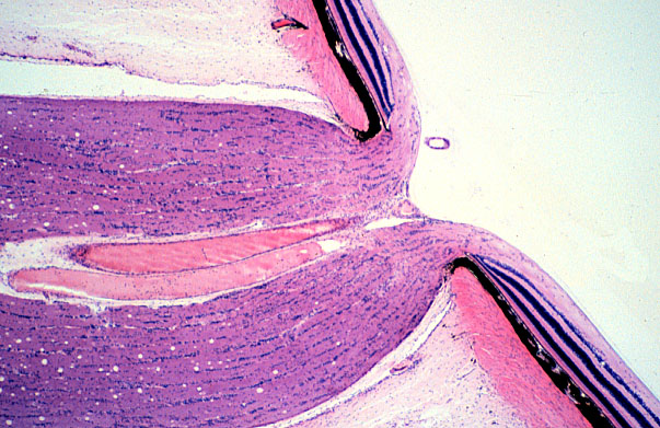  eye, lamina cribrosa 