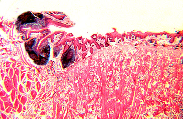  lingual tonsil 