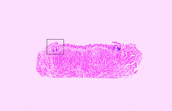  lingual tonsil 