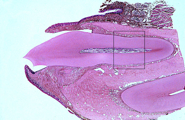  mature tooth 