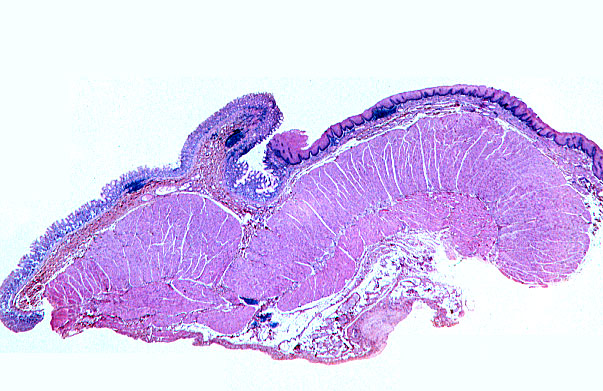  esophageal/stomach junction II 