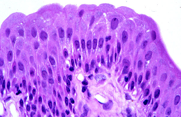  urinary bladder, transitional epithelium 
