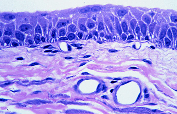  distended transitional epithelium 