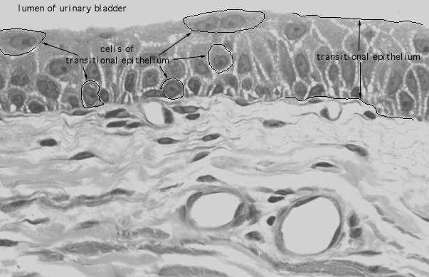  distended transitional epithelium 