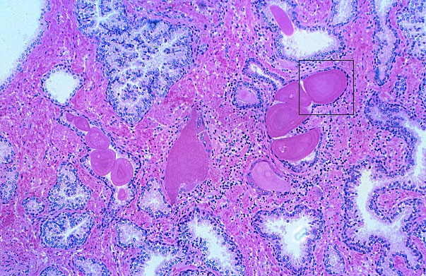  prostate, prostatic concretions 