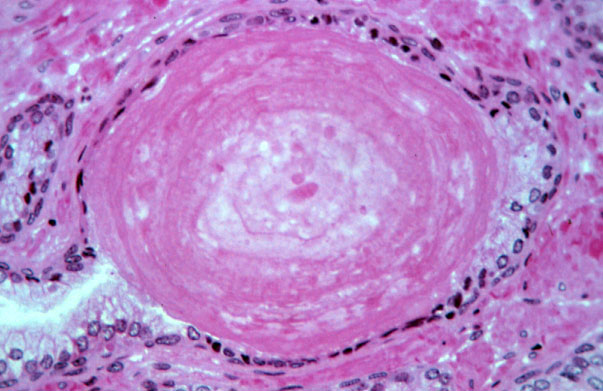  prostate gland, prostatic concretion 