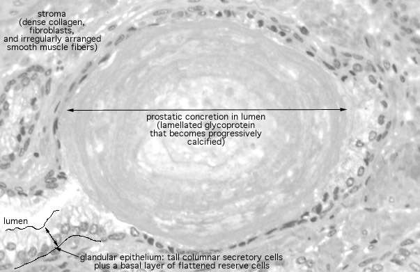  prostate gland, prostatic concretion 