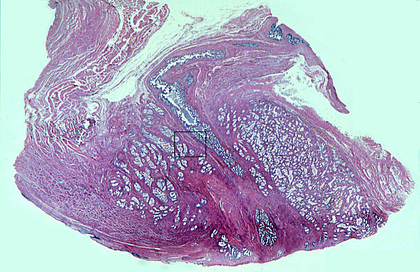  prostate, seminal vesicle 