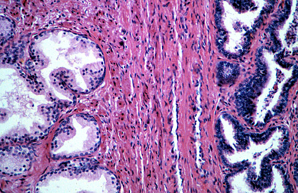  prostate, seminal vesicle 