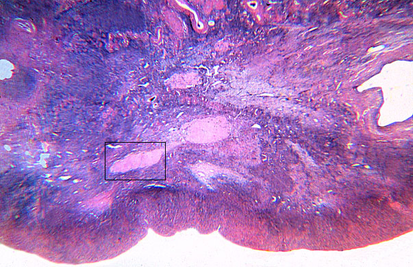  ovary, corpus albicans 