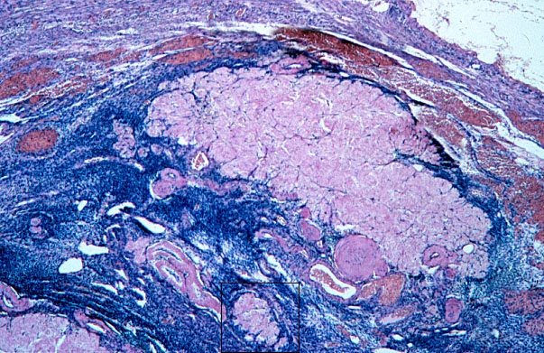 ovary, corpus albicans 