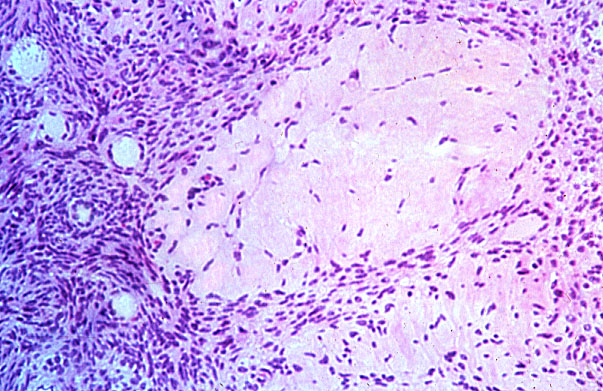  ovary, corpus albicans 