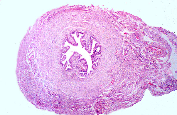  isthmus, distal 