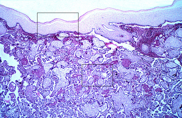  placenta, fetal side 