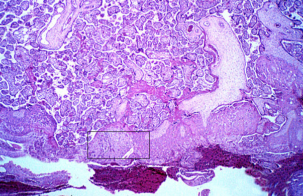  placenta, basal plate 