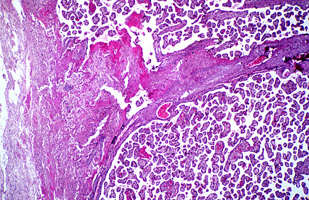  placenta, anchoring villus 