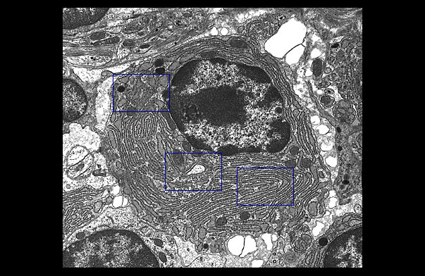  plasma cell 