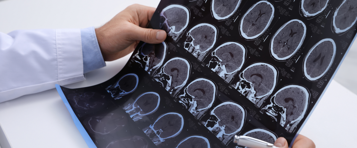 Doctor Examining MRI Images of Patient with Multiple Sclerosis a