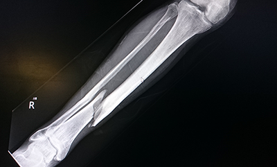 thumbnail-xray-fracture