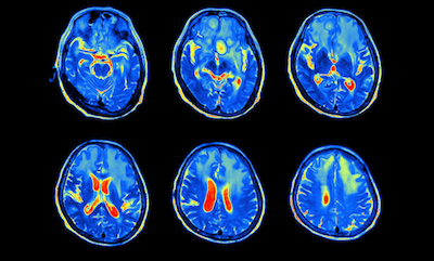 MRI scan of brain