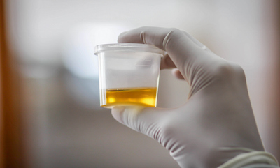 Gloved hand holding urine sample