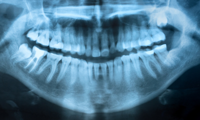 X-ray of a teenager's teeth, showing wisdom teeth coming in