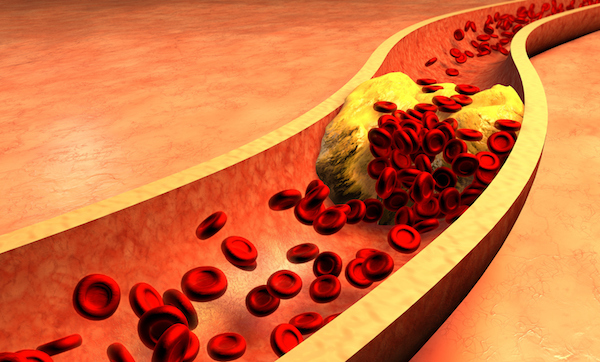 Clogged Artery with platelets and cholesterol plaque, concept for health risk for obesity or dieting and nutrition problems