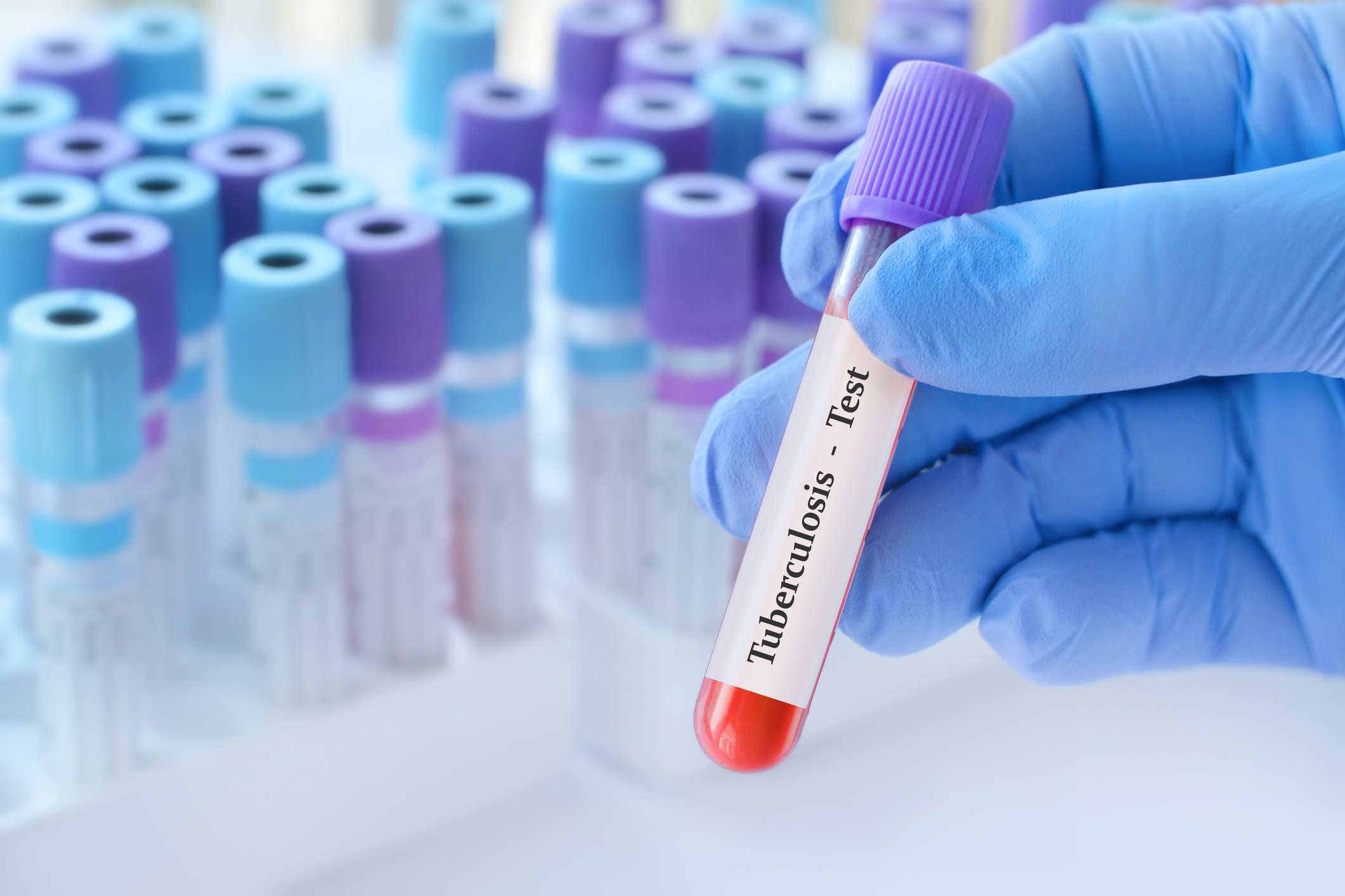 Doctor holding a test blood sample tube with Tuberculosis test on the background of medical test tubes with analyzes.
