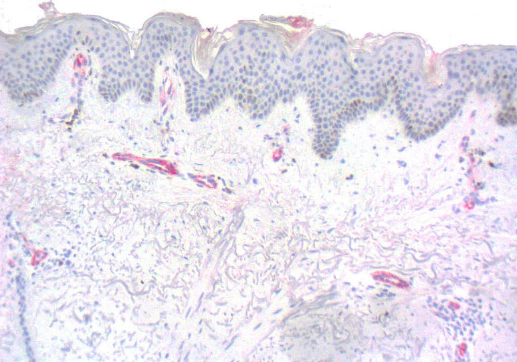 von Willebrand Factor